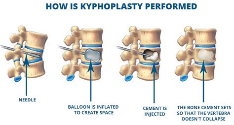 Kyphoplasty Aptiva Health