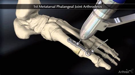 Artrodesis De La Primera Articulación Metatarso Falangica By Arthrex