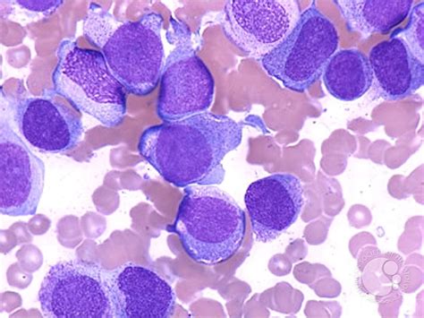 Acute Monocytic Leukemia 2