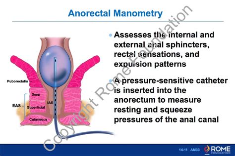 Anorectal 11 Anorectal Manometry Rome Online