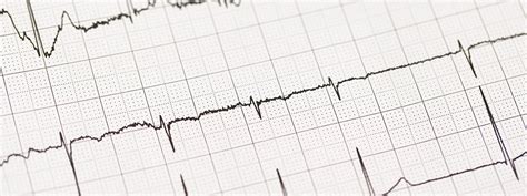 What Are The Different Types Of Arrhythmias Cardiogram