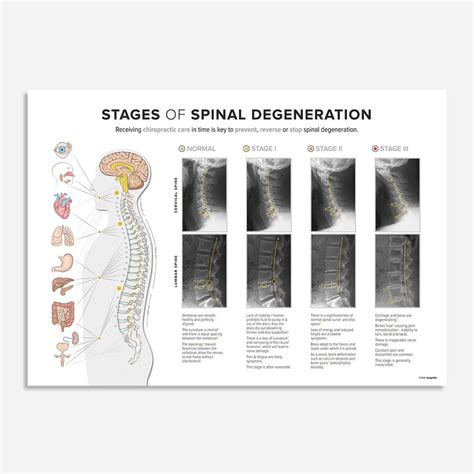 Stages Of Spinal Degeneration Cx Lx Chiropractic Poster