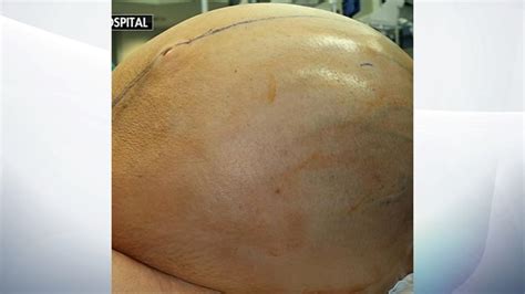 Woman Has 60kg Tumour Removed From Abdomen Us News Sky News