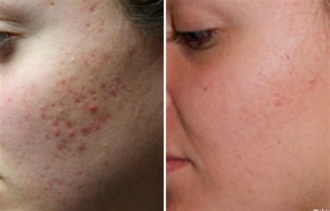 Face Holes Removal Treatment Doctor Heck