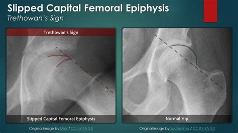 Slipped Capital Femoral Epiphysis Plain Radiography Youtube