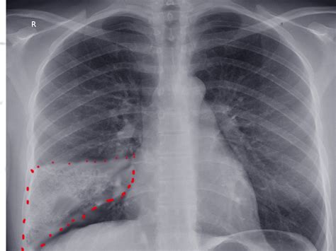 Figure Wedge Shape Pulmonary Infarction Seen On Ap Chest X Ray Image