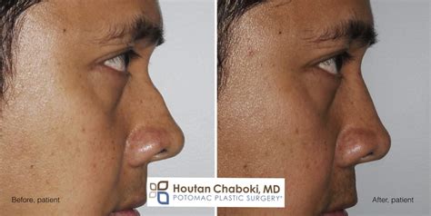 Augmentation Rhinoplasty Without Breaking The Nose