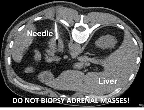 Risk Of Cancer In Adrenal Tumors And Adrenal Masses