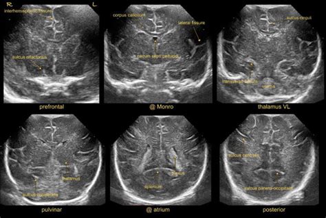 State Of The Art Neonatal Cerebral Ultrasound Techniq