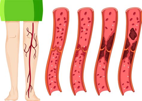 Die wichtigsten informationen zur thrombose: Thrombose | Fußschmerz-Lexikon