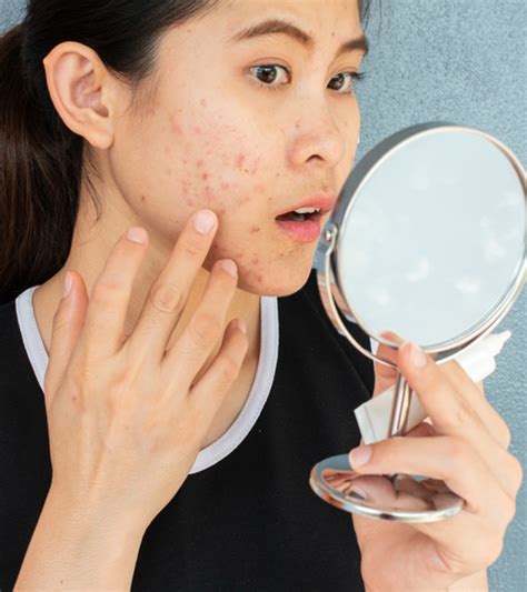 Nodular Acne Causes Treatment Options And Home Remedies