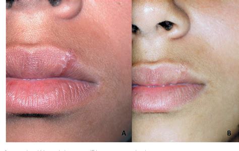 Figure 1 From Pyogenic Granuloma On The Upper Lip An Unusual Location
