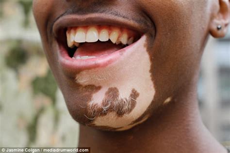 Denver Photographer Captures The Beauty Of Vitiligo Daily Mail Online