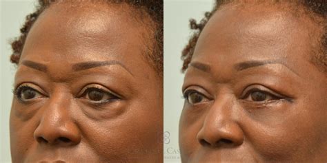 Lower Blepharoplasty And Lateral Canthopexy
