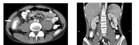 Contrast Enhanced Abdominal Computed Tomography Scan Showing Irregular