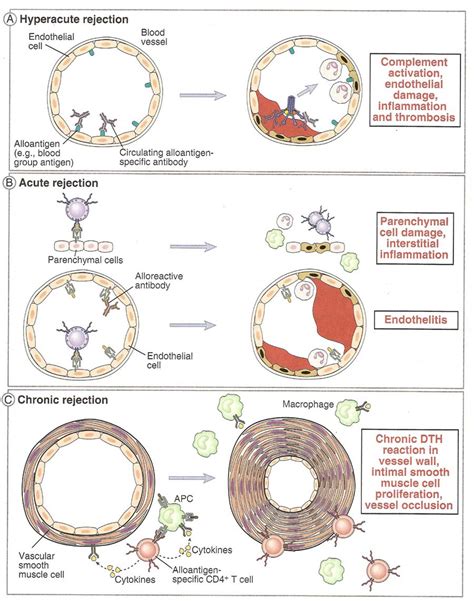 Transplant Immunology Medbullets Step 1