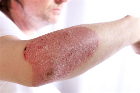 Person With Plaque Psoriasis Of The Arm Stock Photo Image Of Elbow