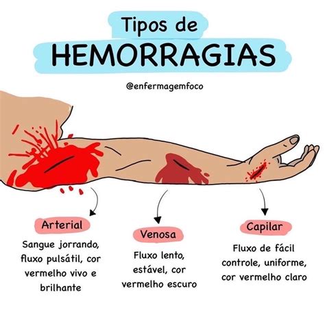 Tipos De Hemorragias Enfermagem Hot Sex Picture Hot Sex Picture