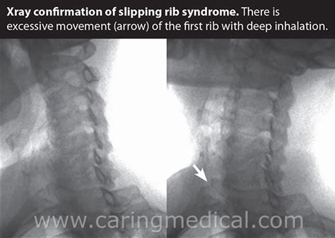 Slipping Rib Syndrome Caring Medical