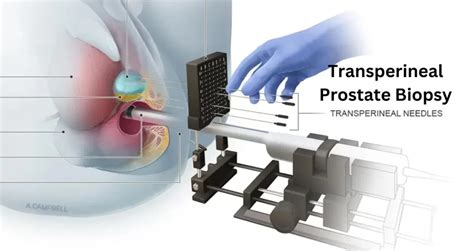 What Is A Transperineal Prostate Biopsy Revealing The Procedure