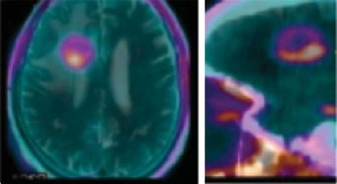 Mri Images Showing Astrocytoma Brain Tumor In Ac Pc And Sagittal