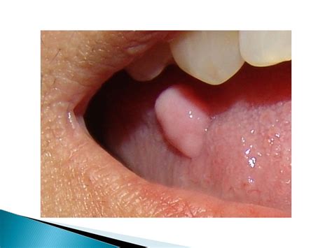 Common Benign Oral Cavity Disorders By Drvijay Kumar