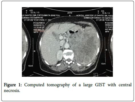 Cancer Science And Research Tomography Large Gist