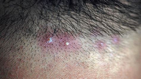 Scalp Folliculitis Signs Causes Treatment And More