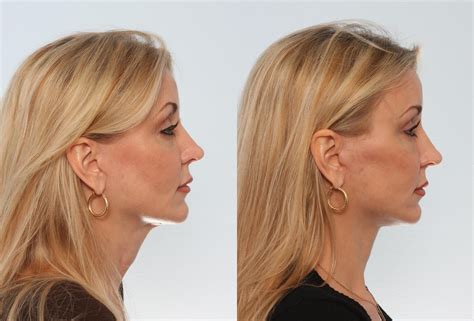 Before After Neck Lift Cape Town Dr Gideon Maresky