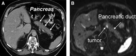 T1 Pancreatic Cancer With Lymph Node Metastasis And Perineural Invasion
