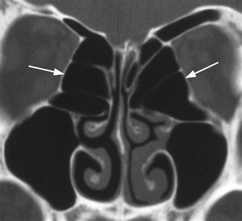 Technology And Techniques In Radiology Ct Image Of The Ethmoid Bulla