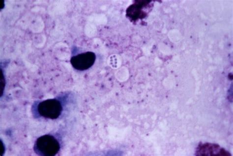 Free Picture Photomicrograph Serohemorrhagic Meningitis Case Fatal