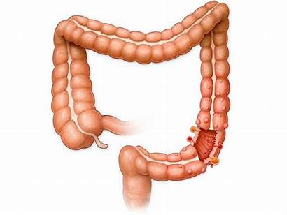 Intestine Appendix Purpose Important Does Why Its