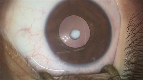 congenital cataract for patients gene vision