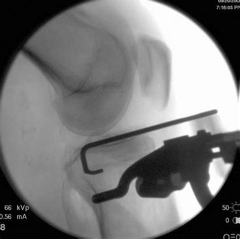Opening Wedge Proximal Tibial Osteotomy Arthroscopy Techniques