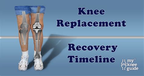 Road To Recovery Following Knee Replacement Knee Replacement Surgery Knee Replacement