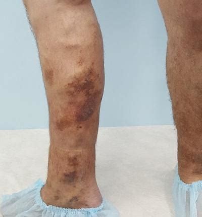 Eczema venoso trofico degli arti inferiori: sintomi ...