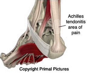 We explain what causes it, how to treat, and how to run the achilles tendon is the thickest and strongest tendon in your body, connecting your calf muscles. Achilles tendonitis diagram | Insertional achilles tendonitis