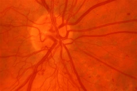 Retina Lancashire Eye Clinic