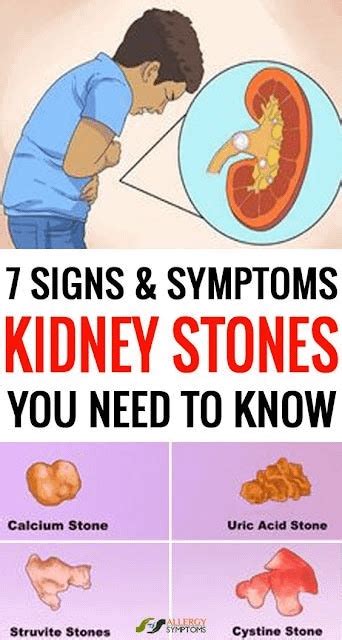 7 Signs And Symptoms Of Kidney Stones You Need To Know Rhealthmgz