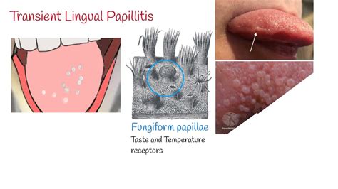 The Different Types Of Lie Bumps Transient Lingual Papillitis