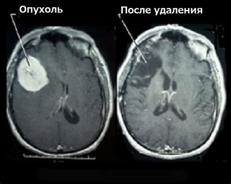 There are two main types of tumors: Опухоль головного мозга - Рак Инфо