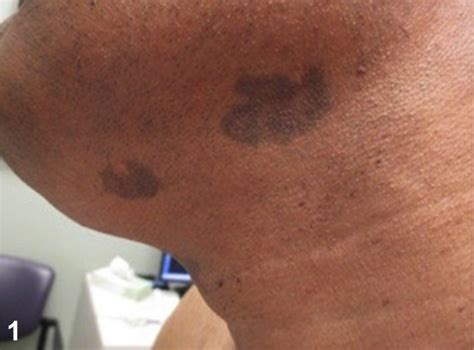 Progressive Hyperpigmented Rash In A Middle Aged Man Journal Of The