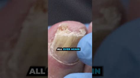 A Solution For Thick Nails Youtube