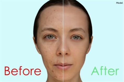 What Can Chemical Peels Do For Acne And Acne Scars Leonard Hochstein Md