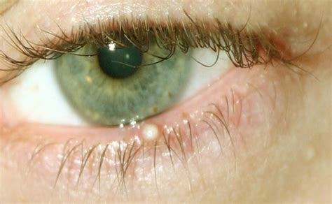 What Causes White Bump On Eyelid Easy Tips And Treatm