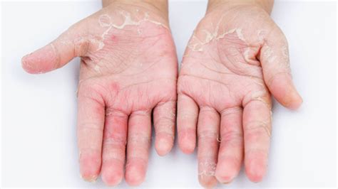 Infected Eczema Pictures Treatment Removal And More