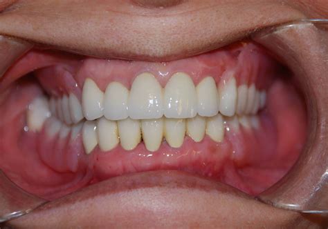Partial Denture Bottom Front Teeth