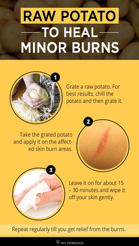 Best Remedies To Heal Minor Burns Diy Natural Home Remedies Home