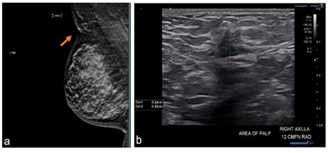 Accessory Breast Cancer A Case Series